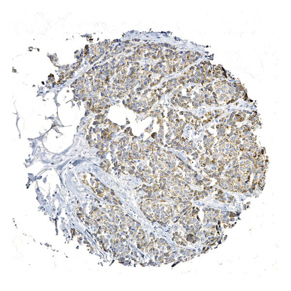 IHC of breast cancer tissue labeled with DSHB antibody CPTC-TACSTD2-3 against Tumor-associated Calcium Signal Transducer 2 (brown). Image credit: NCI-Clinical Proteomic Technologies for Cancer.